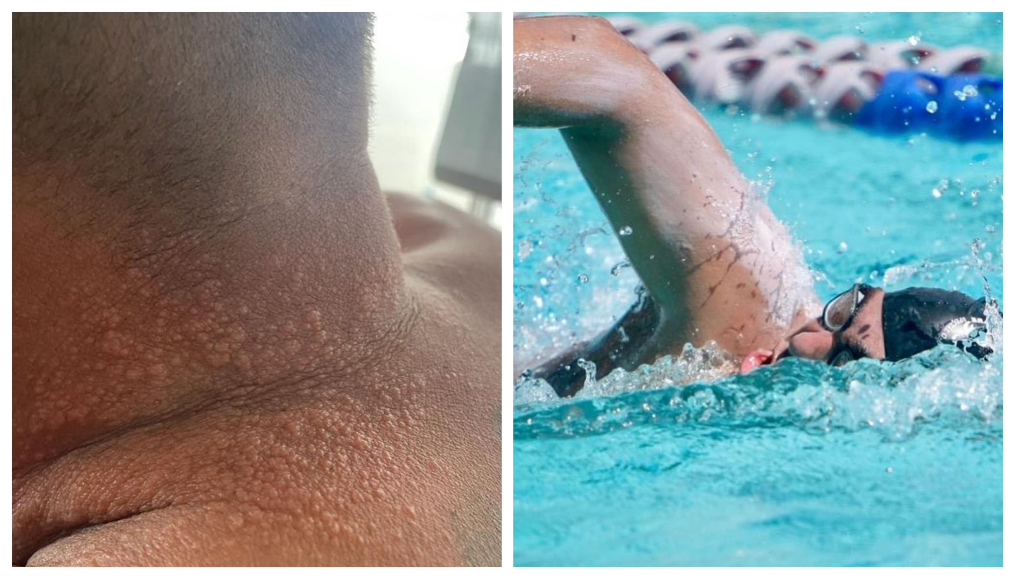 Así se te queda el cuello cuando nadas 200.000 metros en piscina en una semana