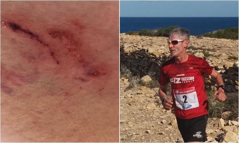 Martín Fiz denunciará al dueño de un perro que le mordió la nalga en Formentera