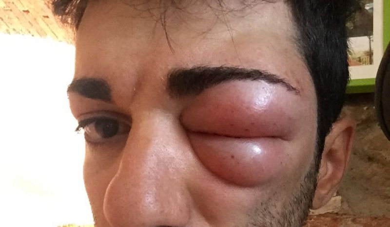"Un pequeño problema" con un insecto deja KO a Celano
