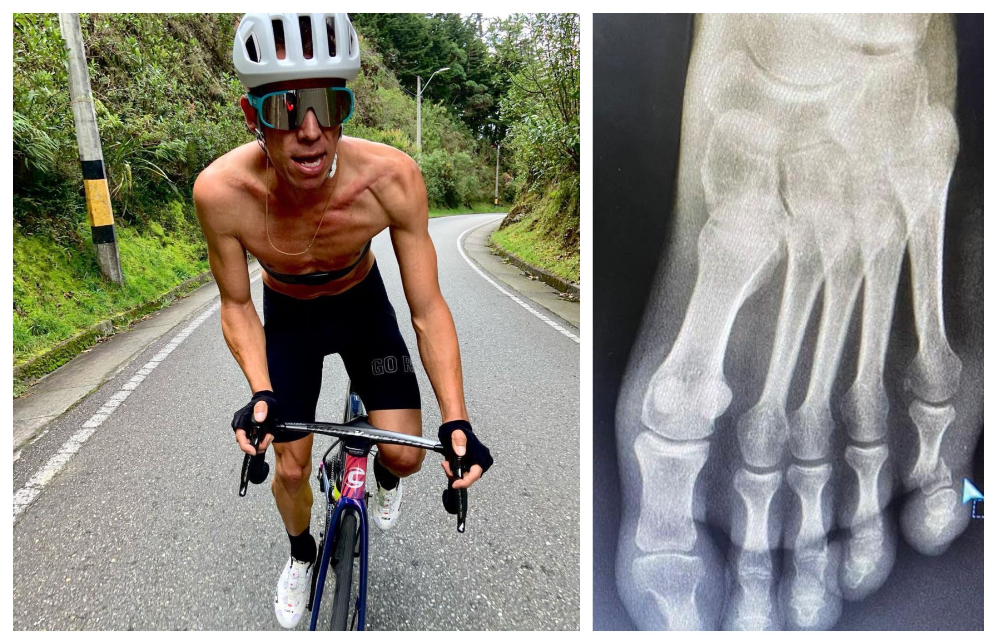 El 'truco' de Rigoberto Urán para seguir entrenando con el dedo del pie roto.